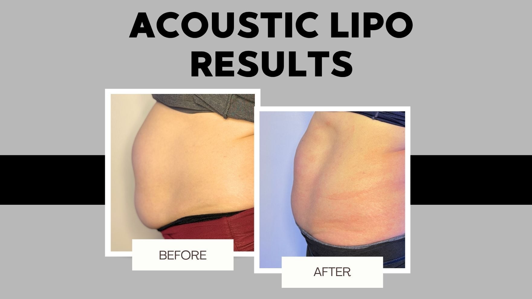 Acoustic Lipo body sculpting treatment information