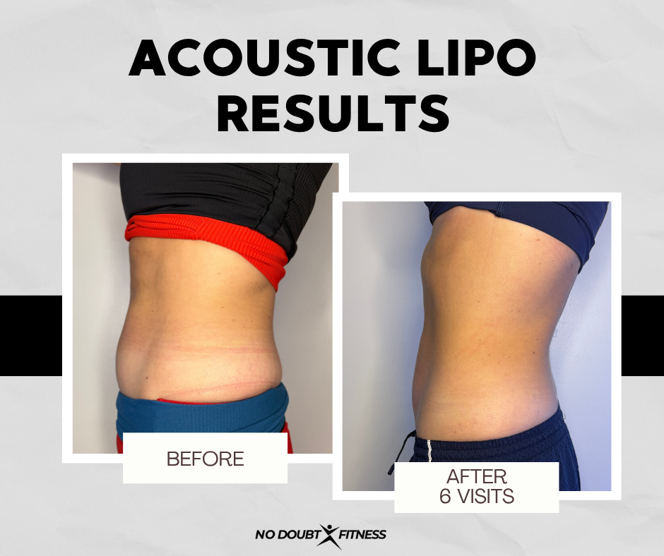 Before and after skin tightening treatment results