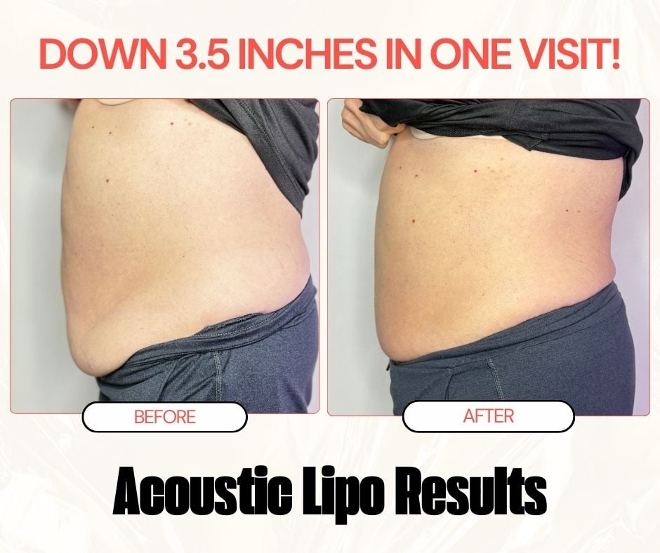 Acoustic Lipo before and after results showing reduced body fat